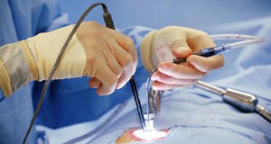 Endoskopska operacija kičme