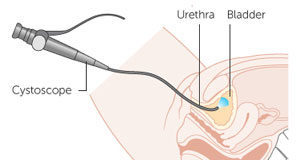 Cistoskopija