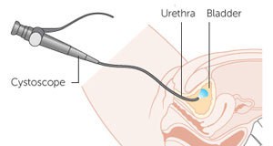Cistoskopija