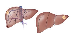 Hirurgija jetre Hirurgija jetre