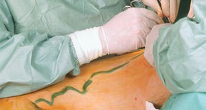 Varicose vein surgery