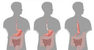 Hirurgija želuca jednjaka