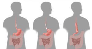 Operacija želuca i jednjaka