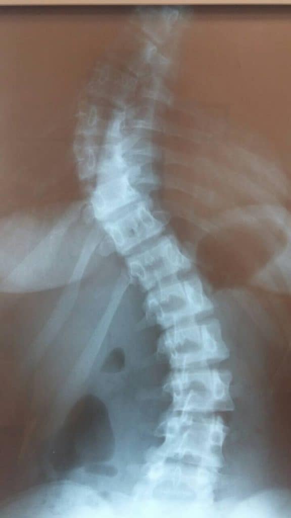 Scoliosis before surgery