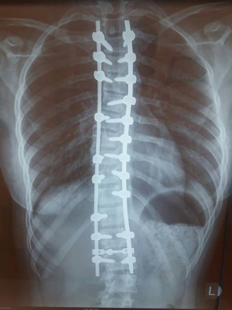 Scoliosis after surgery