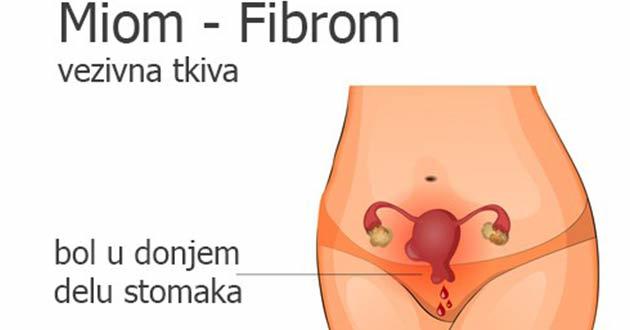 Miom materice Fibrom