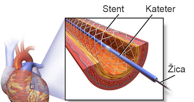 Stent
