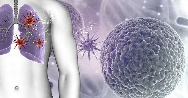 Operacija karcinoma pluca