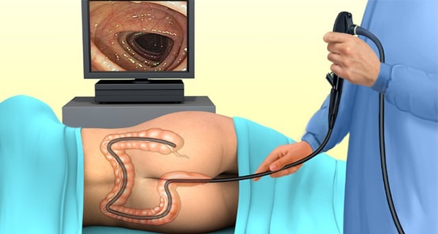 Kolonoskopija - pregled Kolonoskopija - pregled