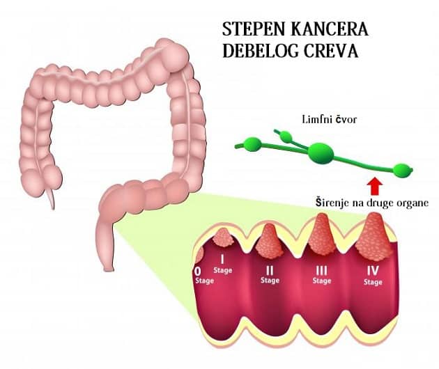 Stepen kancera debelog creva Stepen kancera debelog creva