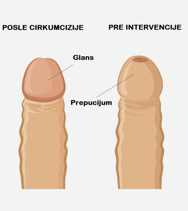 Cirkumcizija pre i posle
