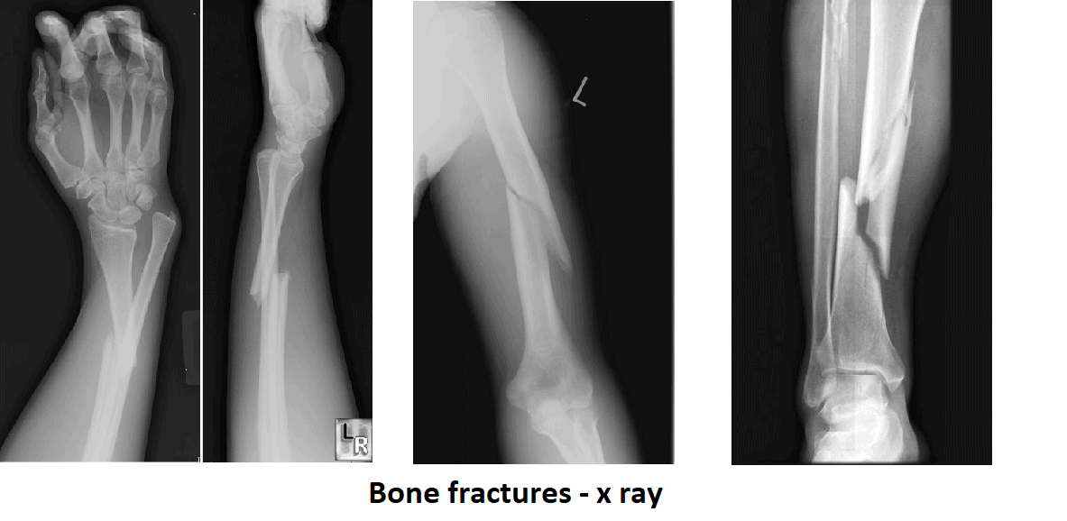 Bone fractures x rays bone fracture - x-ray