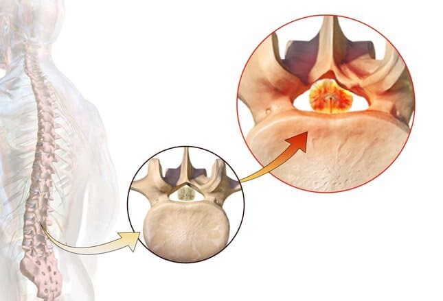 Uklješten nerv na kičmi Uklješten nerv na kičmi