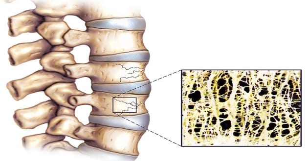vertebral osteoporosis vertebral osteoporosis