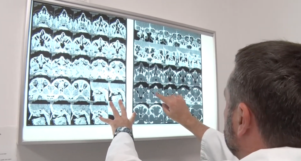 Snimak nazalnih polipa u nosu