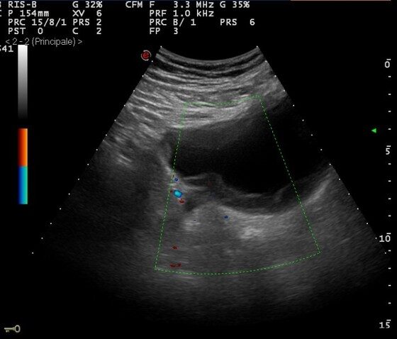 Bladder cancer - ultrasound Bladder cancer - ultrasound
