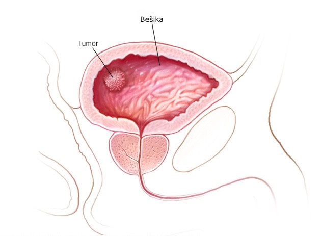 Bladder cancer Bladder cancer