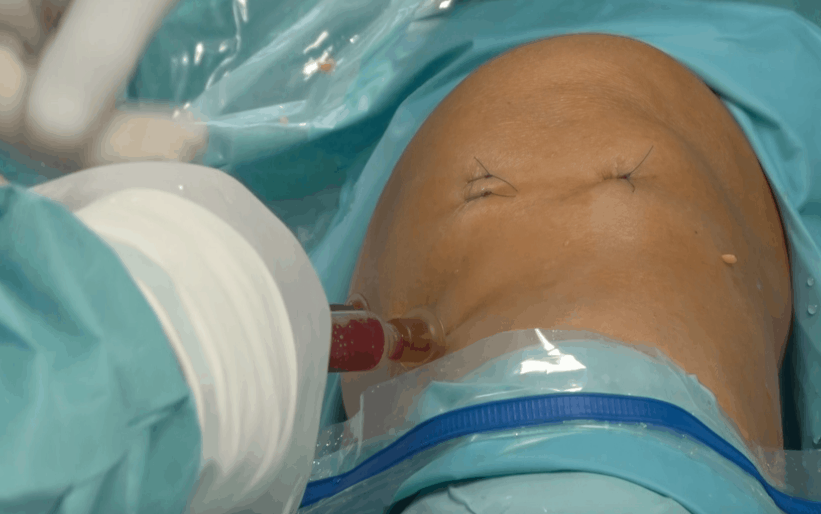 Matične ćelije za lečenje povrede kolena