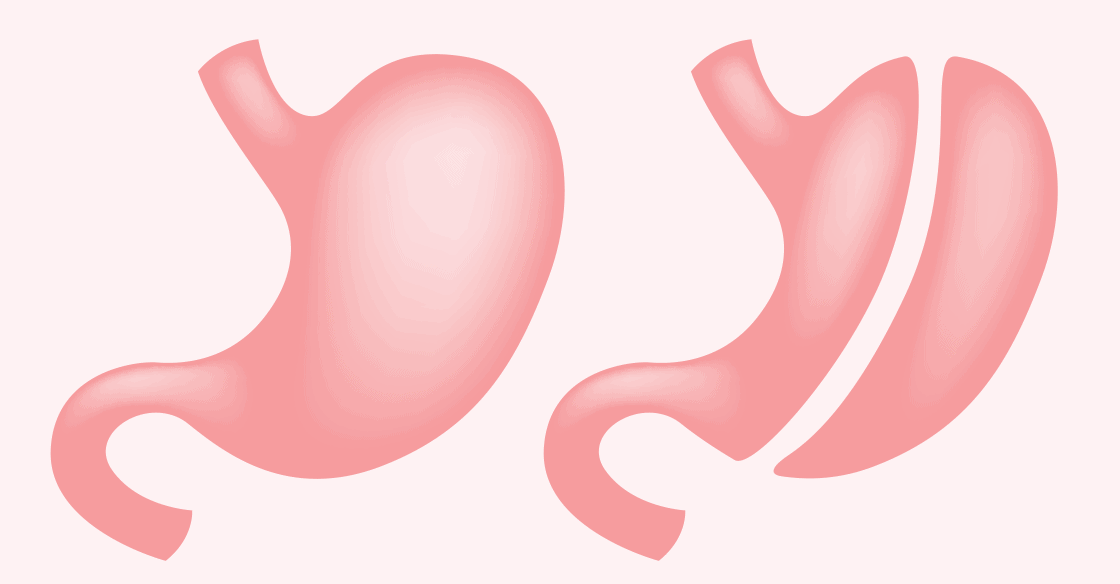 Sleeve gastrektomija - smanjivanje želuca Sleeve gastrektomija - smanjivanje želuca