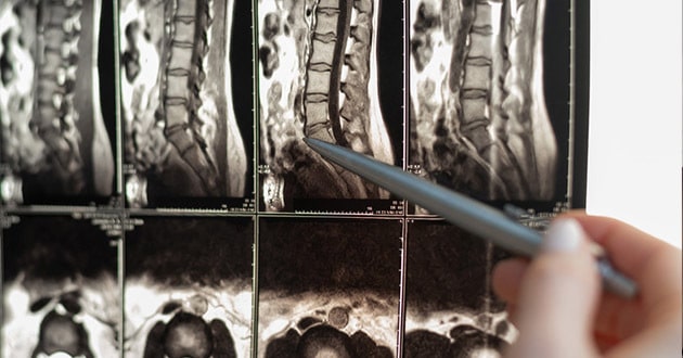 Operacija diskus hernije snimak magnetna