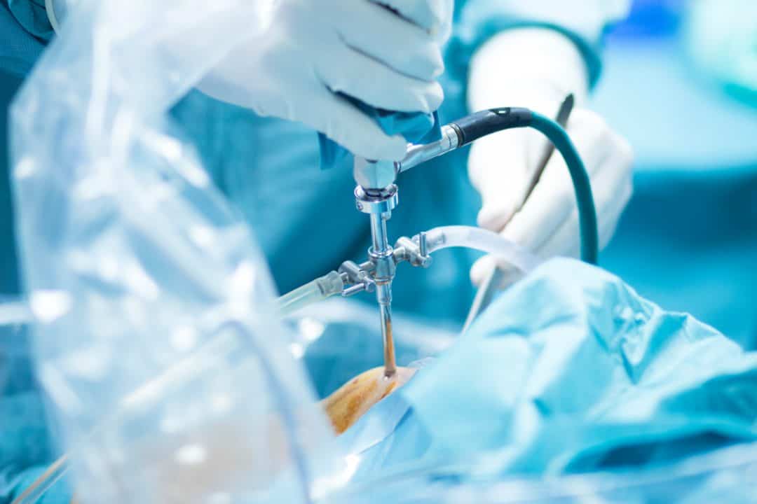 operacija artroskopija kolena